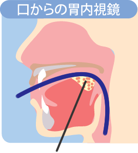 口からの胃内視鏡