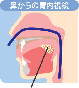 鼻からの胃内視鏡