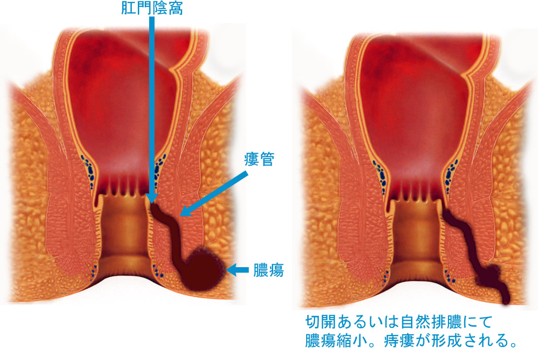 注射 後遺症 ジオン